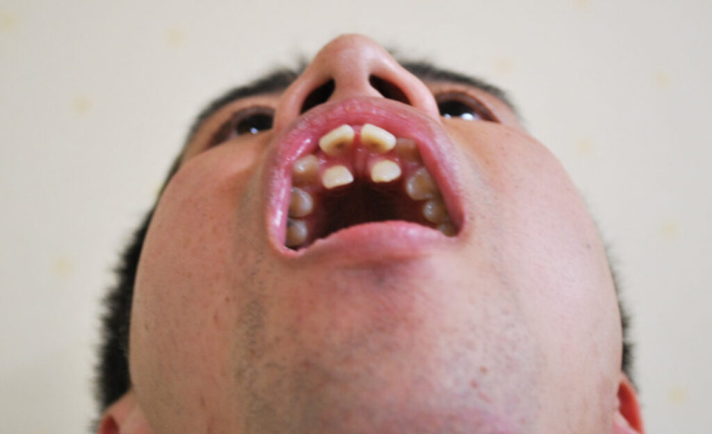 ウエストランドの井口の前歯が異常？口の中の画像も！ | ピュアファクト